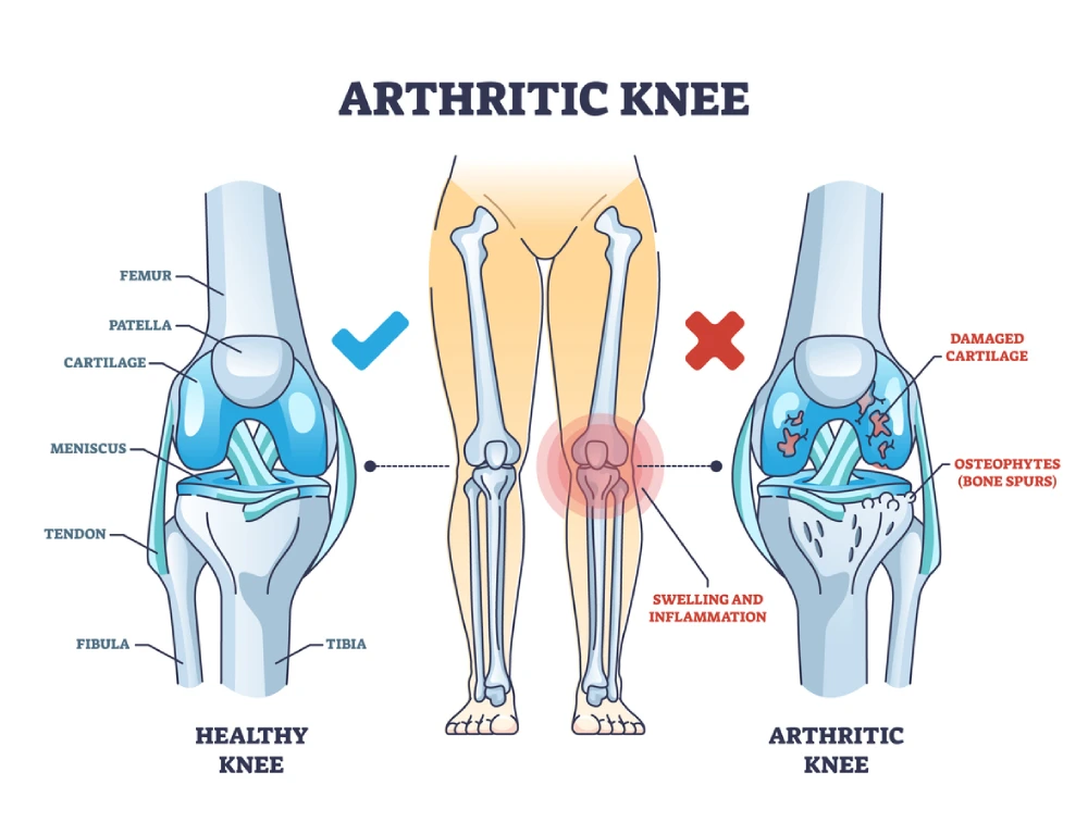 how arthritis can affect the knee joint