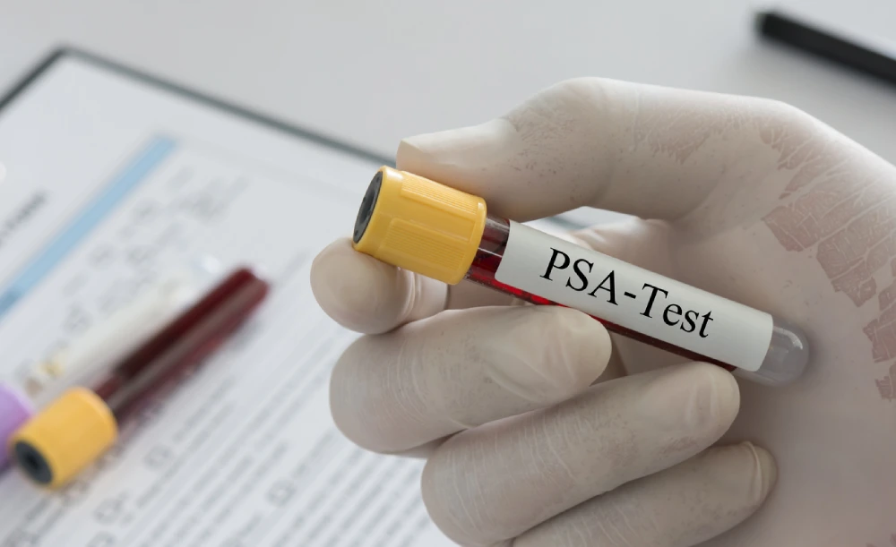 prostate cancer screening test - PSA blood test