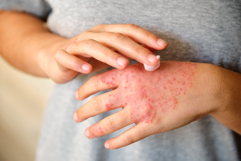 Learn more about how to treat eczema at your local pharmacy.