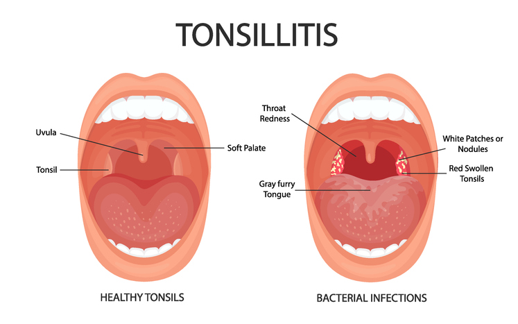 Discover how to treat tonsillitis at your local PharmaChoice pharmacy.