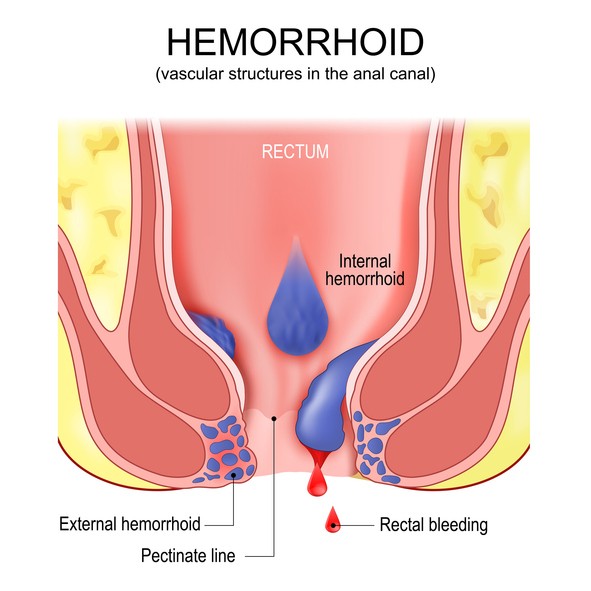 Learn more about treating hemorrhoids at your local pharmacy.
