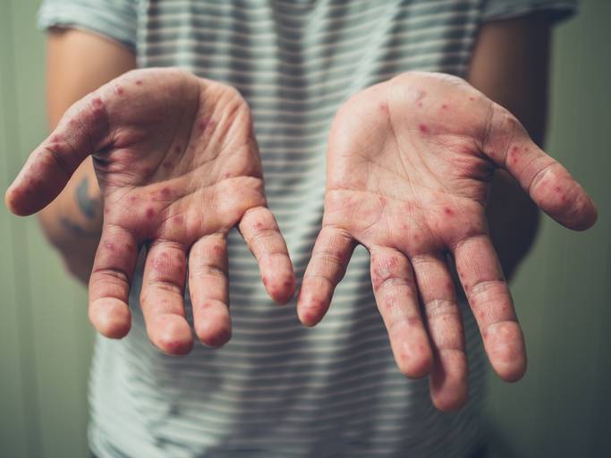 Ease the symptoms of Hand Foot and Mouth Disease. Talk to your local pharmacist.