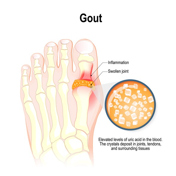 What causes gout in feet? Talk to your local pharmacist today to learn more about the causes and prevention of gout.
