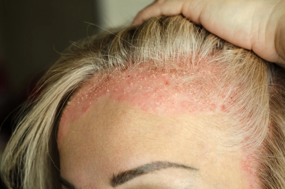 Learn more about treating scalp psoriasis at your local PharmaChoice pharmacy.