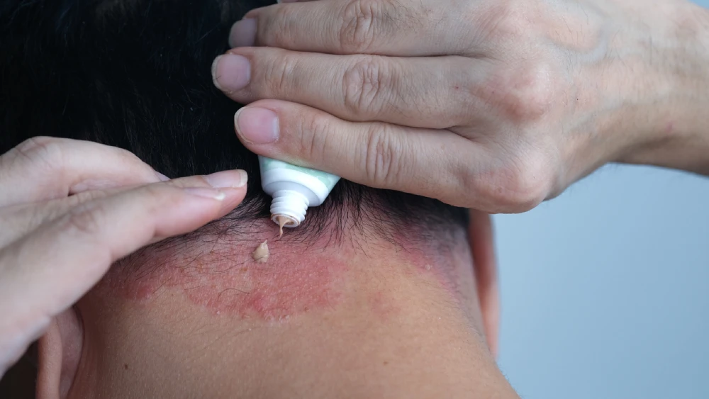 Talk to your local PharmaChoice pharmacist about treatments for scalp psoriasis