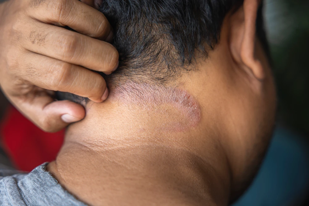 Talk to your local pharmacist today about the symptoms of scalp psoriasis.