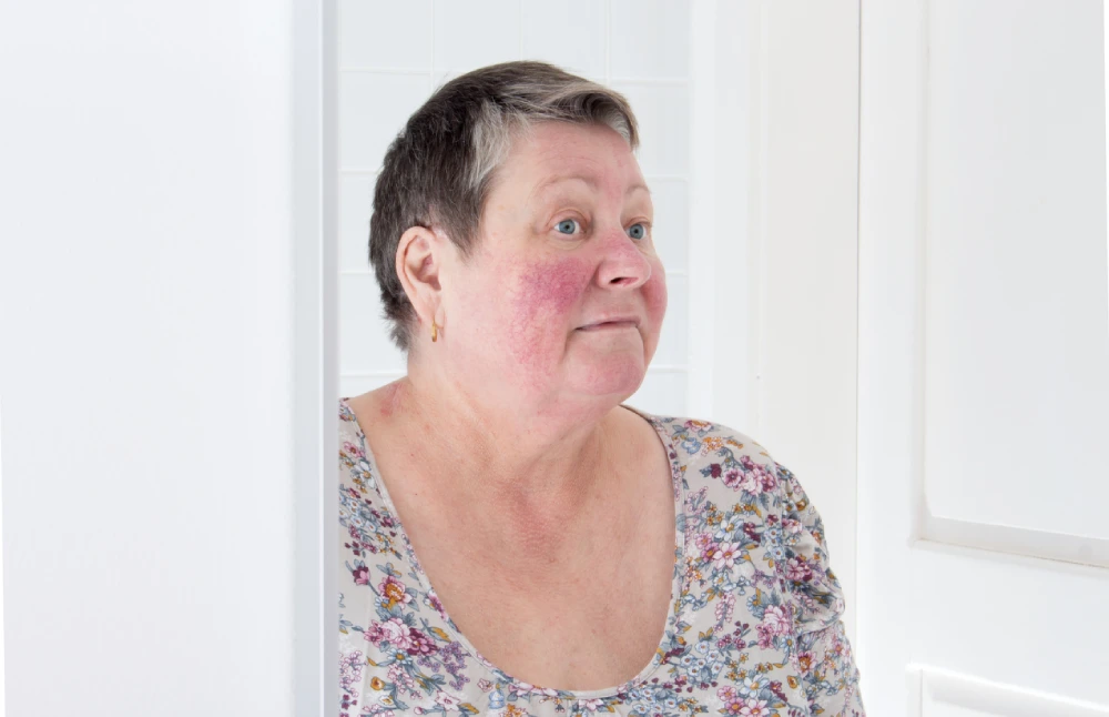 Learn more about rosacea treatment at your local PharmaChoice pharmacy.