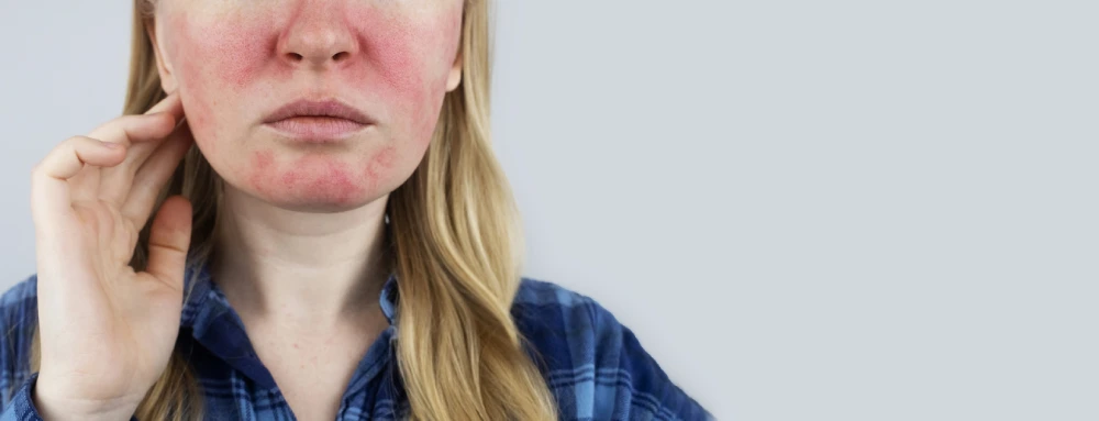 Talk to your pharmacist today to learn more about the signs and symptoms of rosacea.