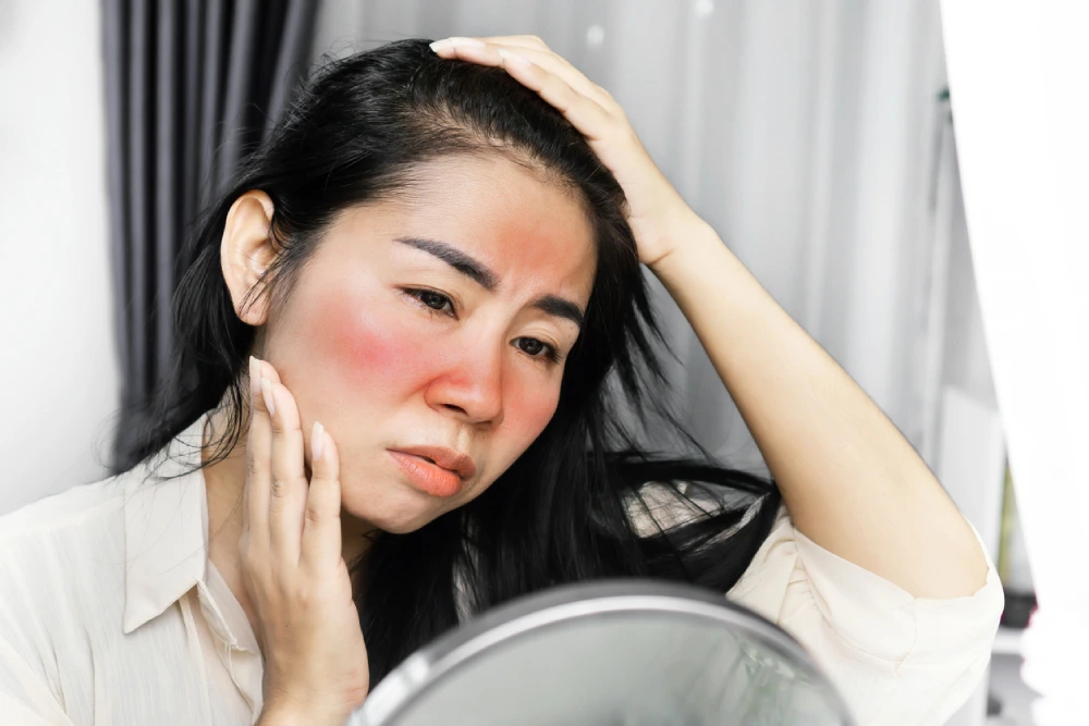 An asian woman with a butterfly rash on her face, one of the common lupus symptoms