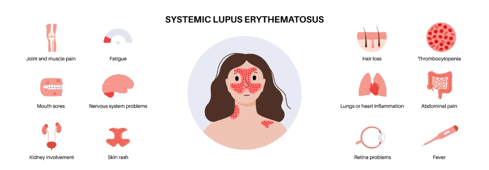 lupus symptoms such as joint and muscle pain, mouth sores, skin rash and hair loss