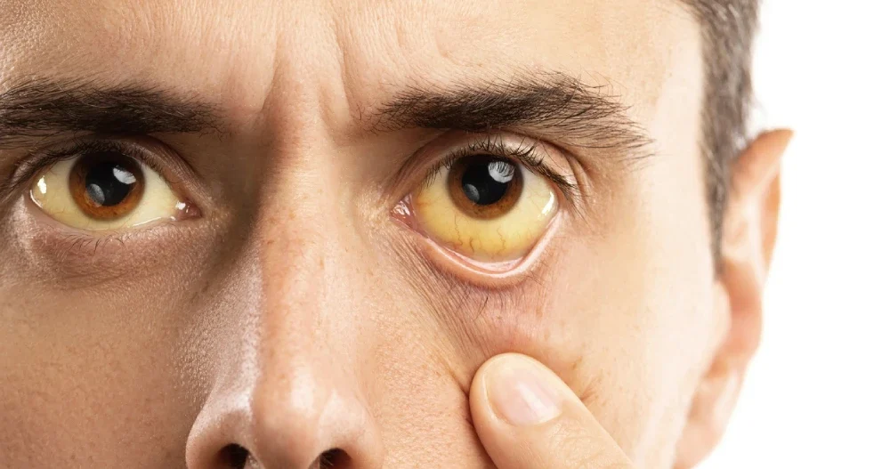 jaundice symptoms in the eyes - yellow eyes