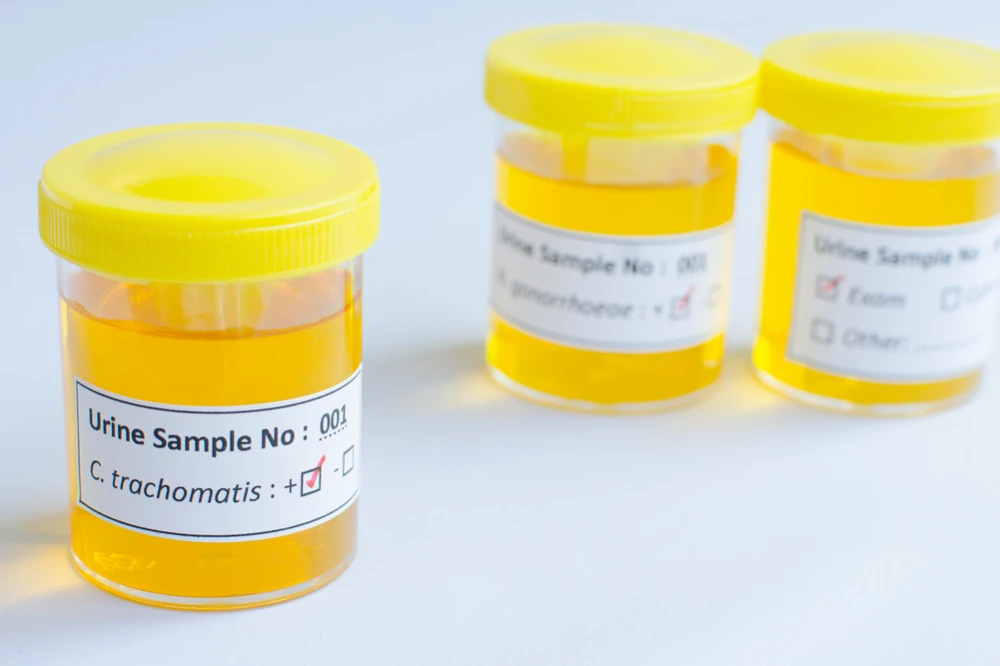 urine tests for chlamydia