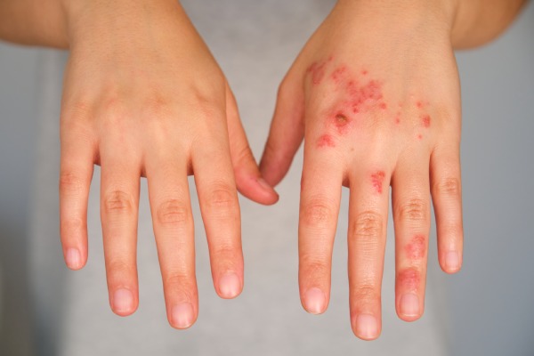 Learn how to treat Hand Foot and Mouth Disease in Adults at your local PharmaChoice pharmacy.