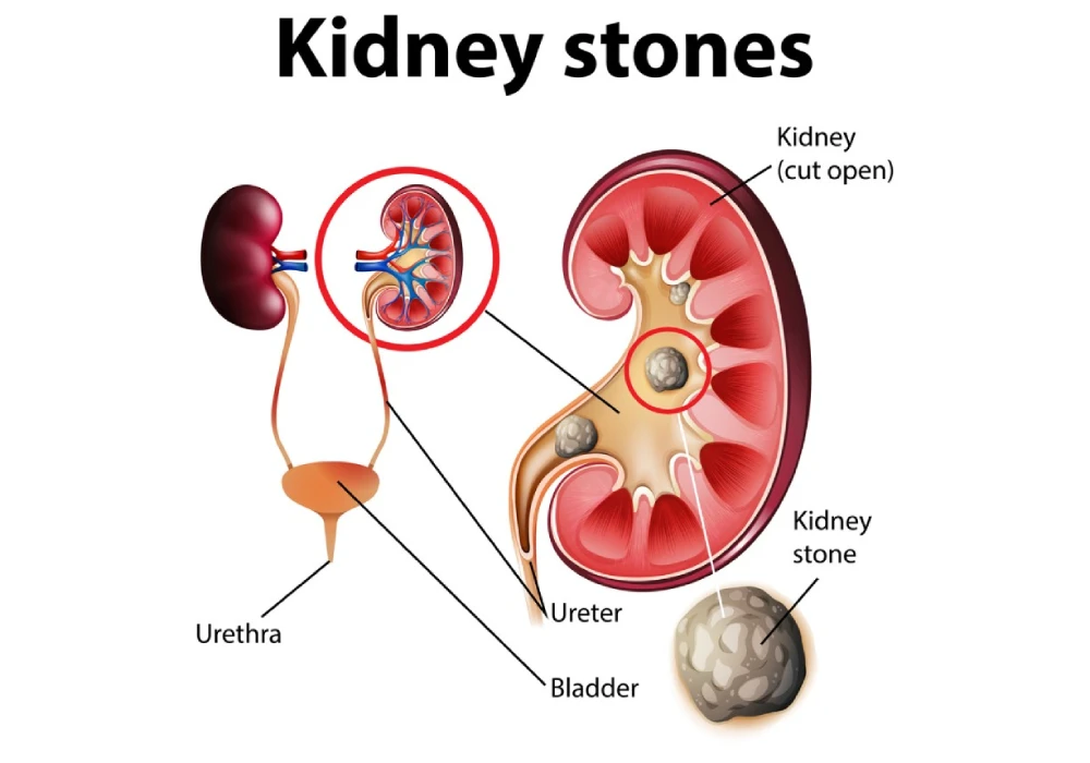 Learn about kidney stone symptoms at your local pharmacy