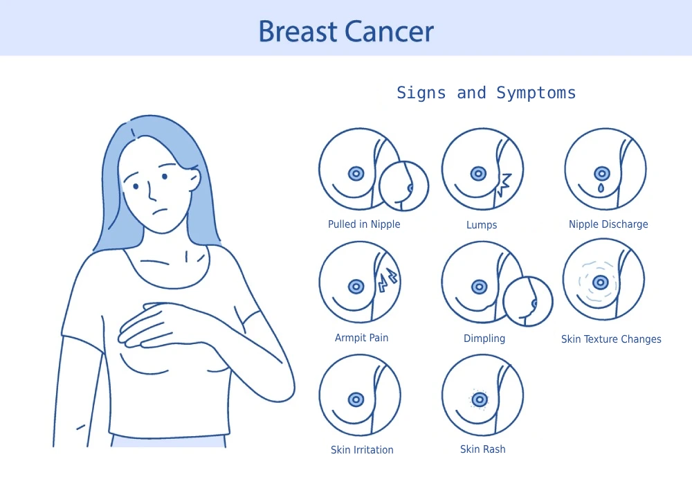 Breast Cancer Signs, Symptoms & Treatment 1 breast cancer signs and symptoms