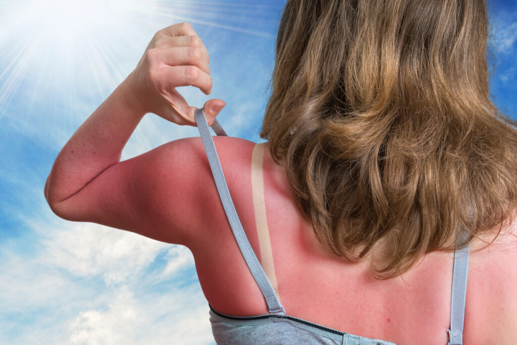 Sun Safety and Your Medications: Photosensitivity Guide 1 Young woman with red sunburned skin on her back.