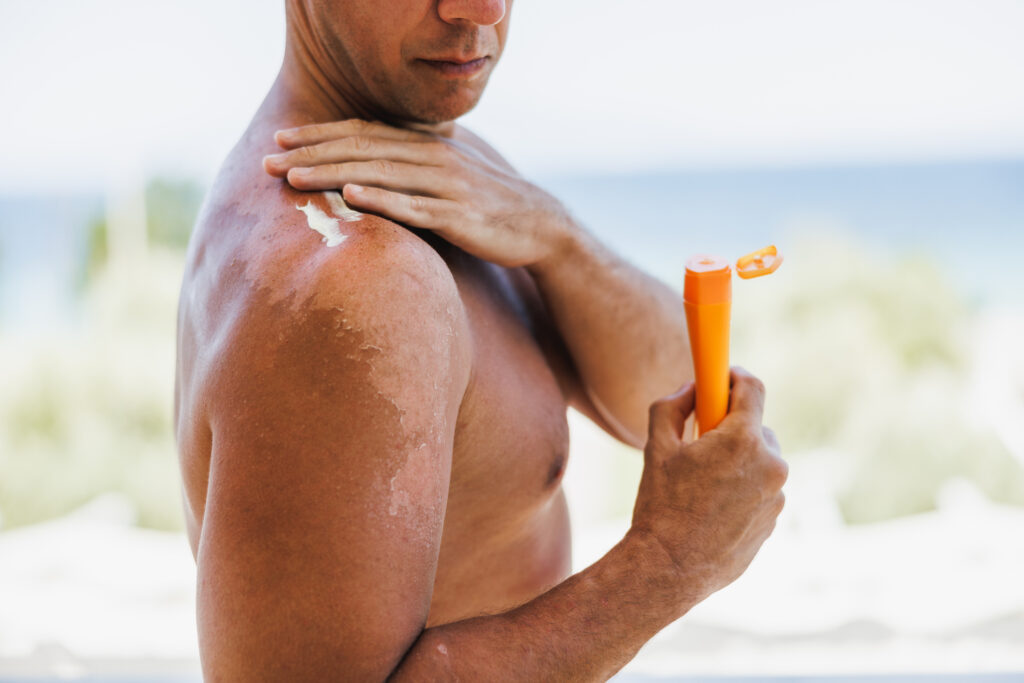 Sun Safety and Your Medications: Photosensitivity Guide 2 A man applies sunscreen to his peeling skin.