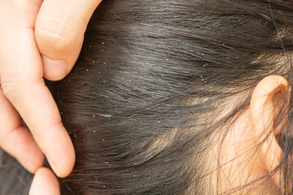 Lice is shown in a person's dark brown hair. 